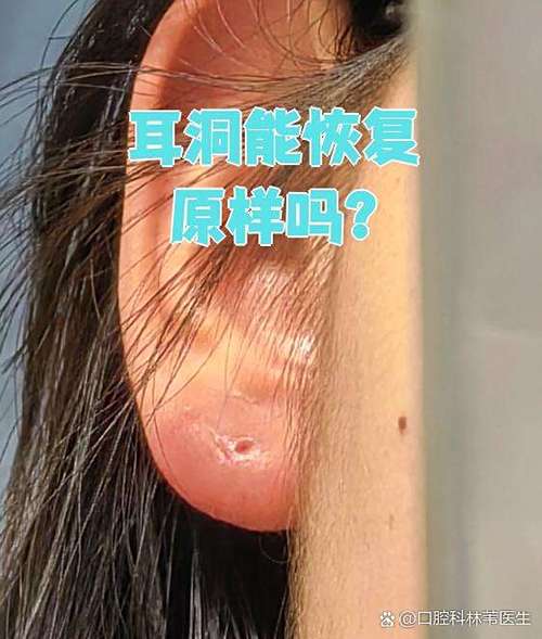 带耳机会使耳洞变大吗