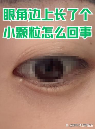 眼睛珠旁边长了小肉球怎么办