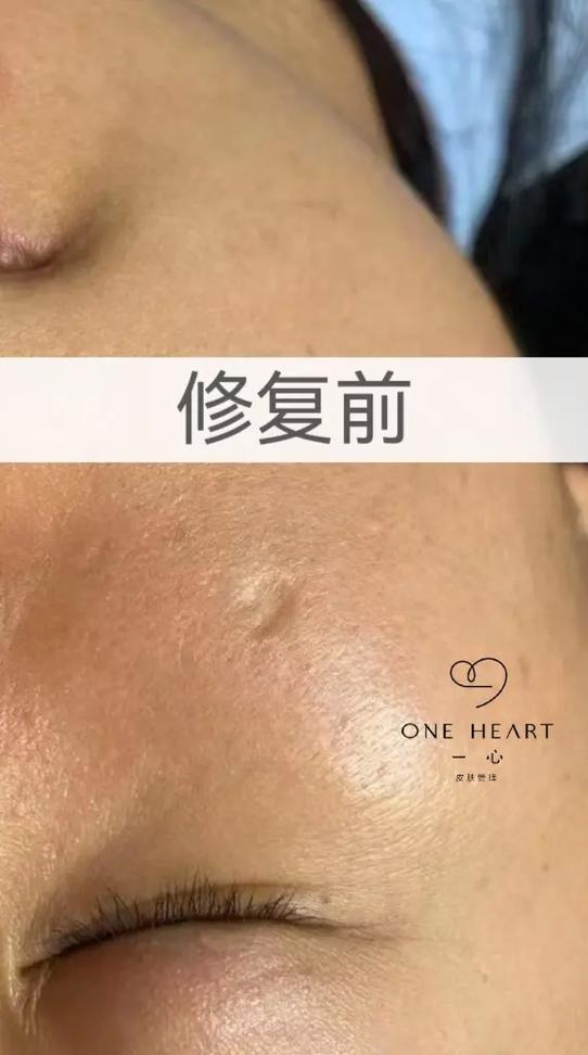 脸上痘坑可以修复吗图标