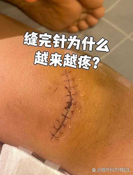 伤口发生了粘连怎么办
