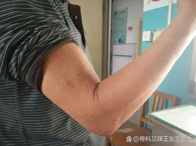 手臂中间弯曲的地方疼