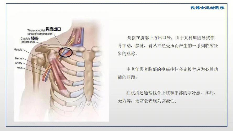 胸廊出口综合症怎么治