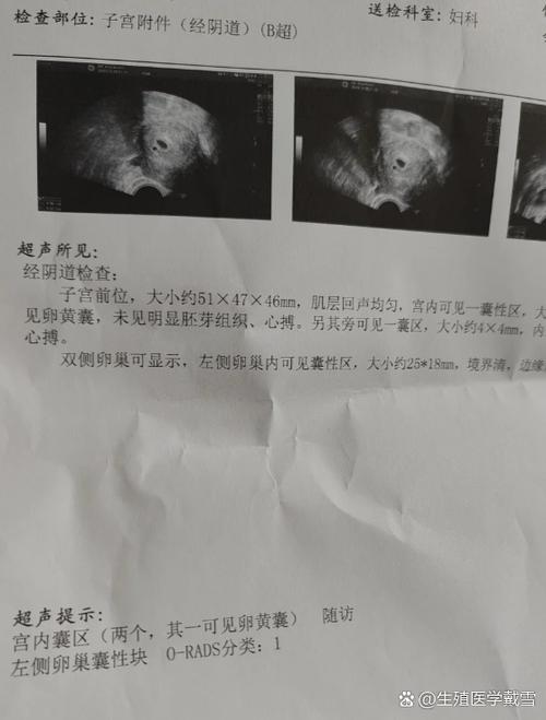 早孕7周无孕囊只有暗区