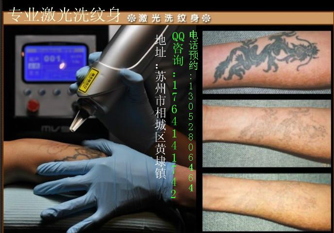 去医院洗纹身多少钱