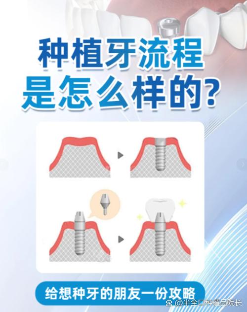 种植牙第二次手术基台要取出吗
