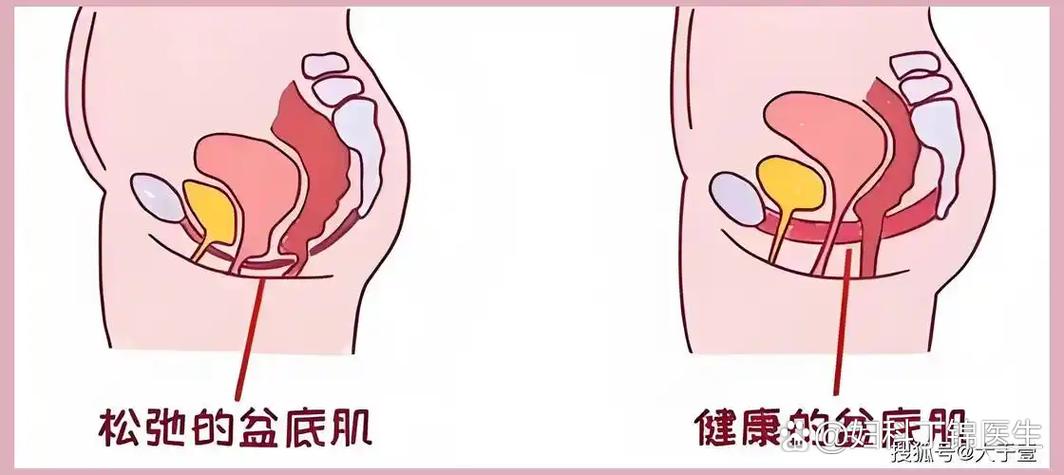 修复盆底肌可以变紧致吗