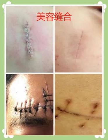手术美容线缝合疤痕图片